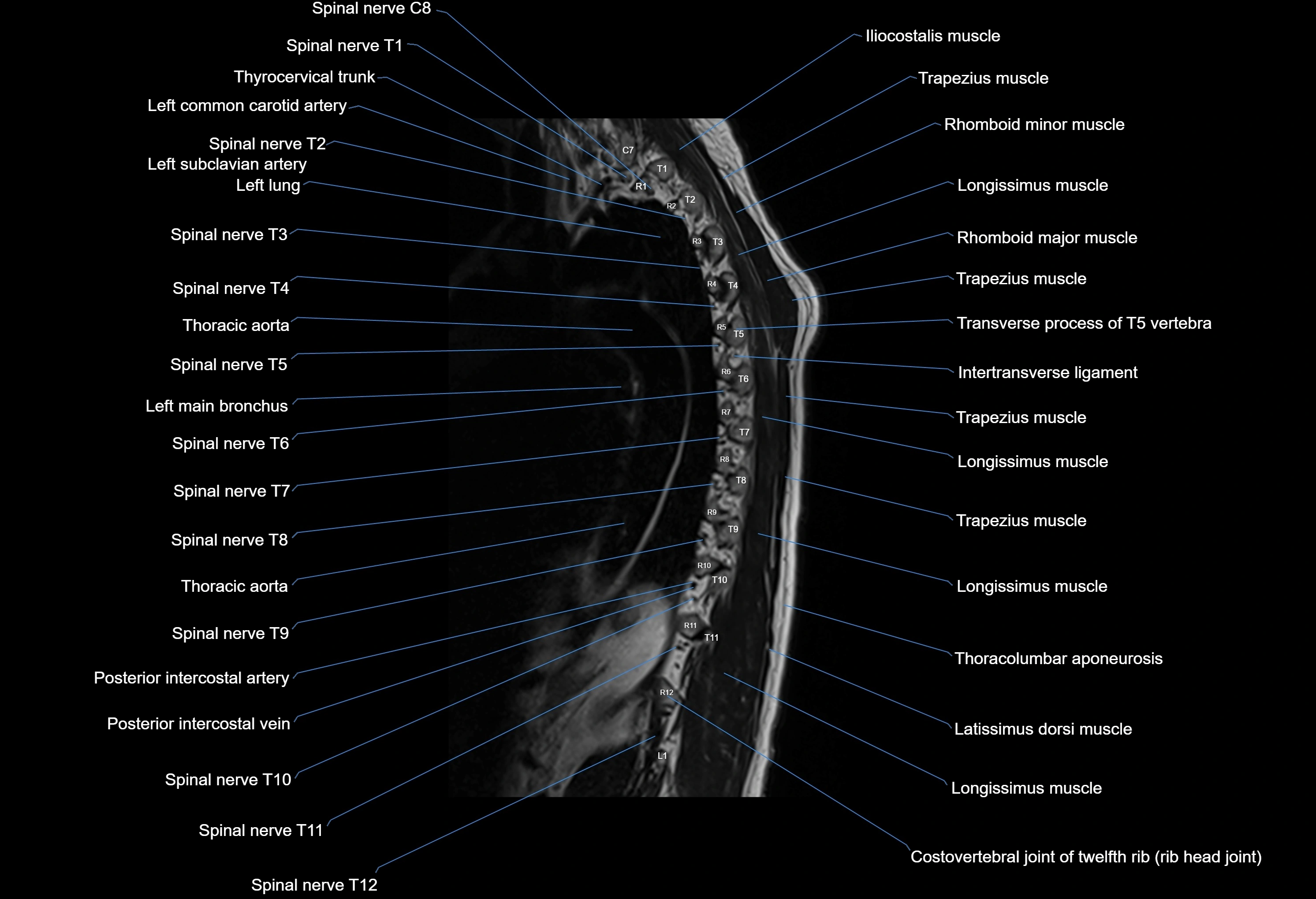 MRI thoracic spine sagittal  cross sectional anatomy 3T radiology  image-img-00001-00024.webp